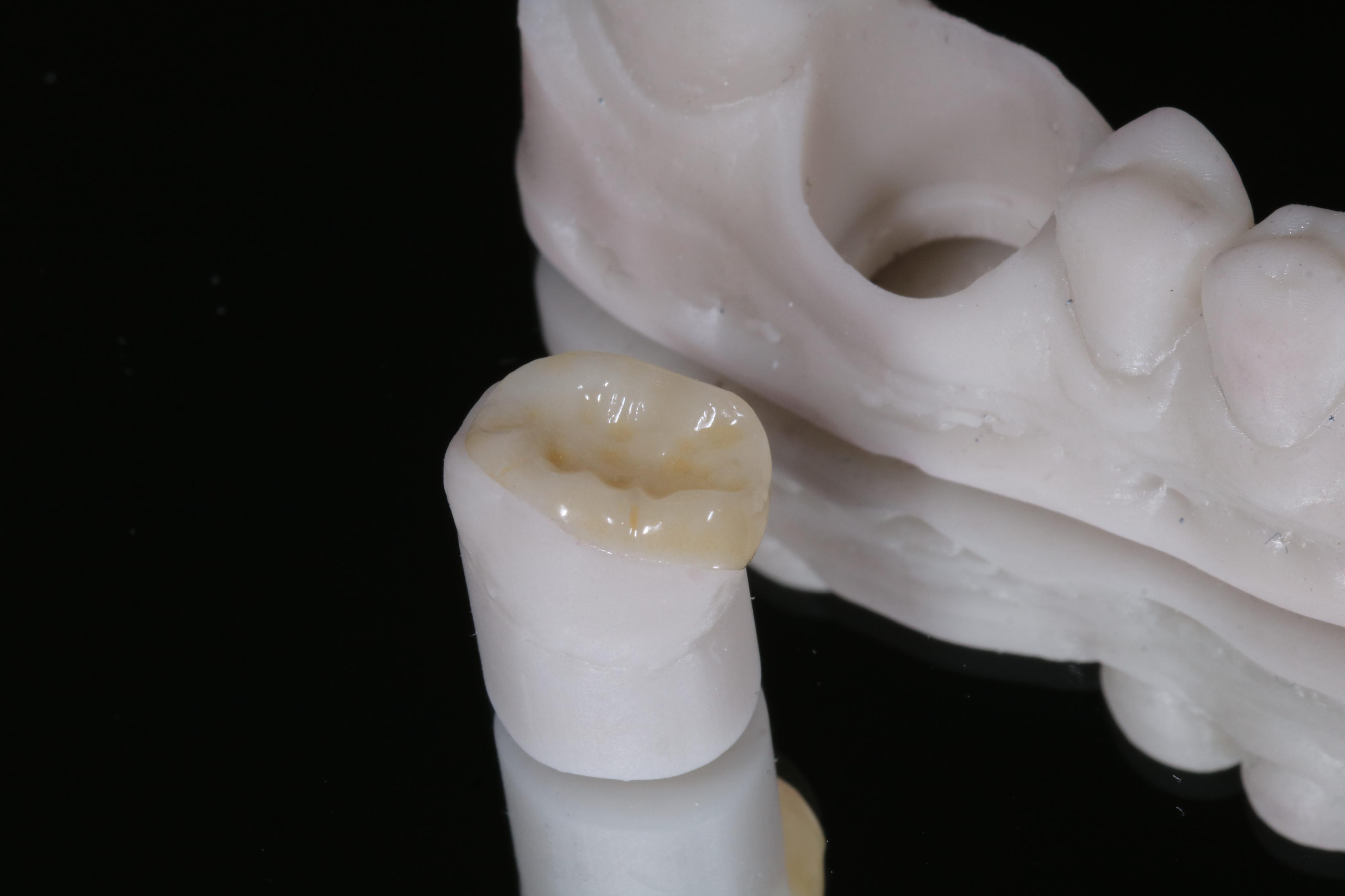 Coroa dentária produzida no laboratório digital da Constancio Odontologia